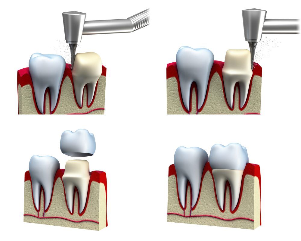 Crown Lengthening Lake Plaza Dental Locust Grove Dentist Crown Lengthening Lake Plaza Dental Locust Grove Dentist